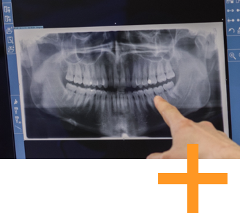 Zahnerhalt Röntgenbild
